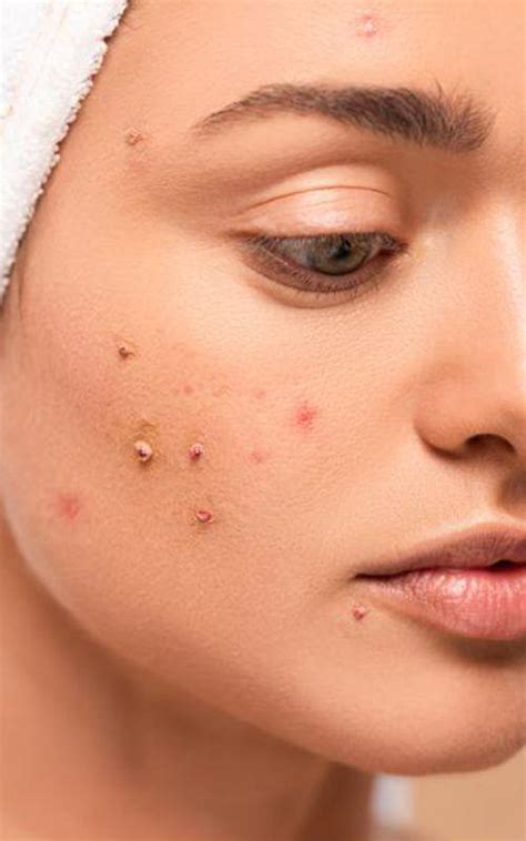 Understanding Acne